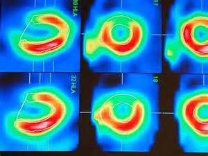 Novel agent improves myocardial perfusion imaging in patients with obesity