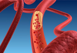 EMA approved Repatha (Evolocumab) to treat uncontrolled cholesterol