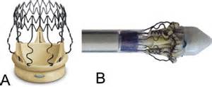 In a win for LivaNova, the FDA approves the world's only sutureless aortic valve