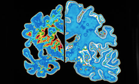 Transition Therapeutics Announces Results of Data Analysis from ELND005 Phase 2/3 Clinical Study in Agitation and Aggression in Alzheimer's Disease Patients