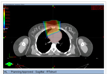 Toxicity, second cancers cause researchers to question radiation’s role in Hodgkin lymphoma