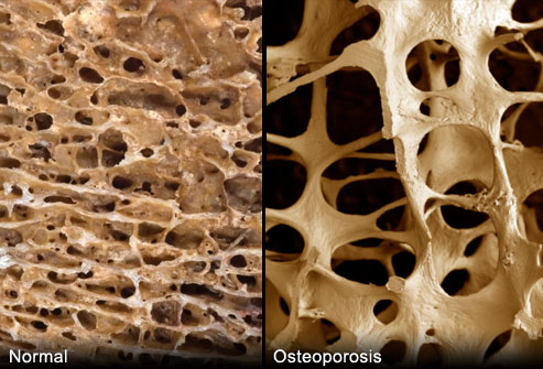 Tarsa Therapeutics’ NDA for TBRIA(TM), the First Oral Calcitonin for the Treatment of Postmenopausal Osteoporosis, Accepted for Filing