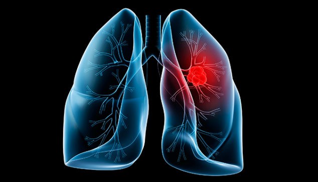 FDA expands approved use of Opdivo in advanced lung cancer