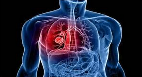 FDA approves new pill to treat certain patients with non-small cell lung cancer