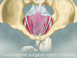 FDA strengthens requirements for surgical mesh for the transvaginal repair of pelvic organ prolapse to address safety risks