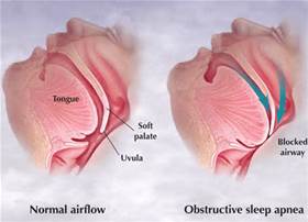 Diagnostic tool reliably predicted obstructive sleep apnea