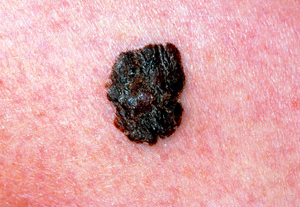 Novartis receives EU approval for Tafinlar and Mekinist, first combination approved for patients with aggressive form of melanoma