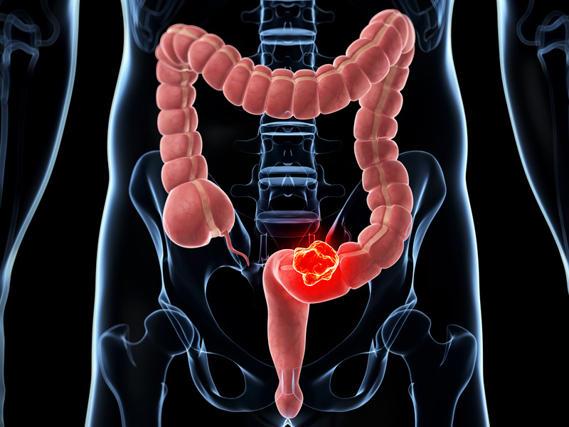 FDA approves new oral medication to treat patients with advanced colorectal cancer