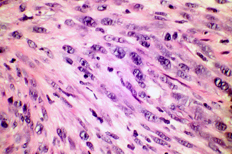 FDA approves new therapy for certain types of advanced soft tissue sarcoma