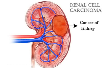 Cerulean Announces Completion of Enrollment of Randomized Phase 2 Trial of CRLX101 in Combination with Avastin® in Relapsed Renal Cell Carcinoma