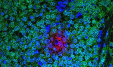 Exploiting breast tumor cells’ survival mechanism to stem tumor growth