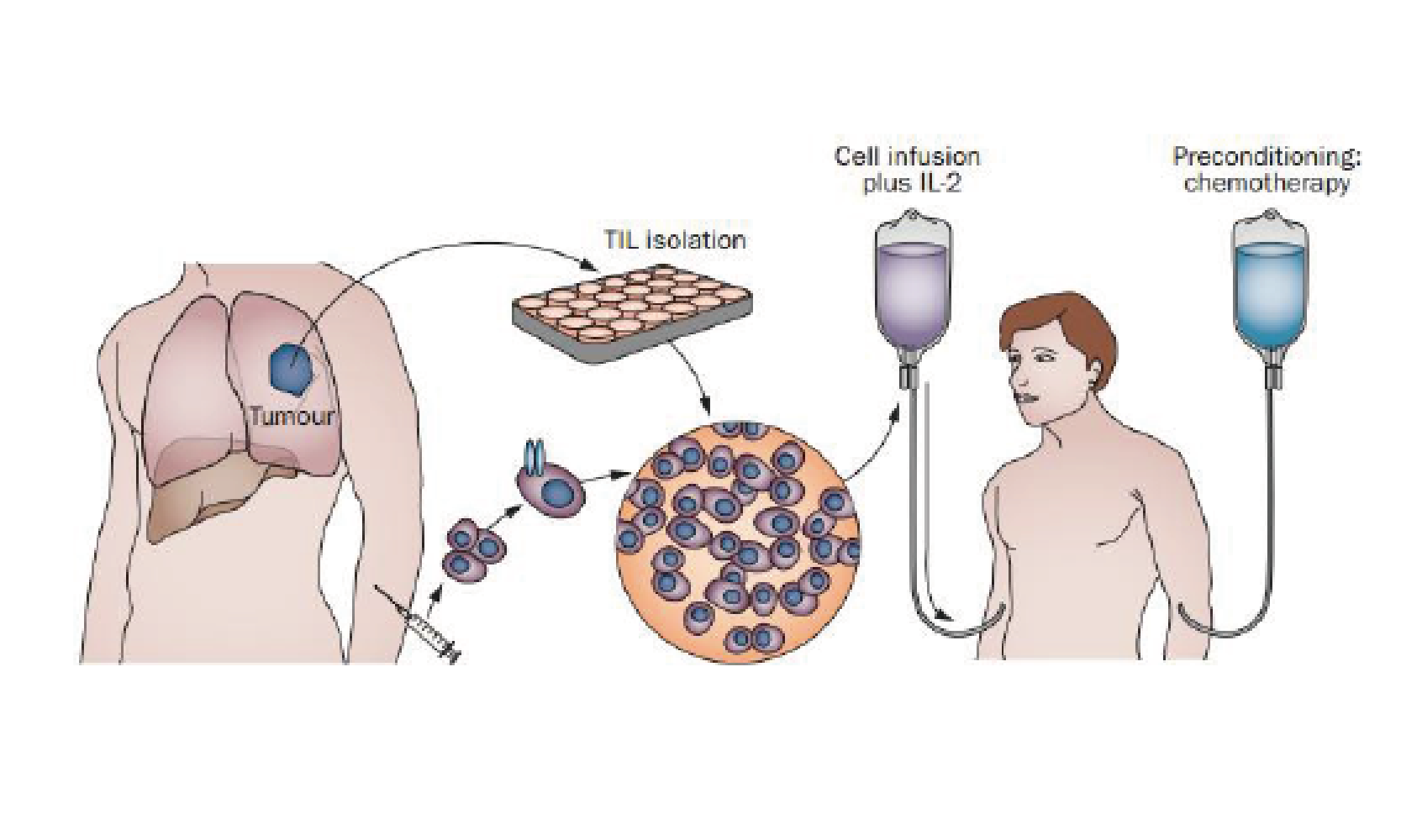 Lion Biotechnologies Obtains Exclusive License From NIH to Develop and Commercialize TIL in Bladder, Lung, Breast and HPV-Associated Cancers