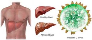 DAA therapy for HCV aids in deactivation, delisting of transplant patients