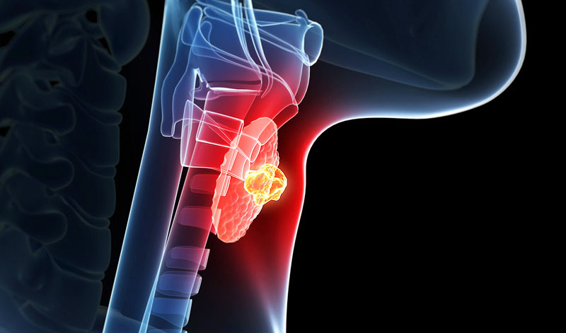 Advanced Radioactive Iodine Refractory Differentiated Thyroid Cancer 