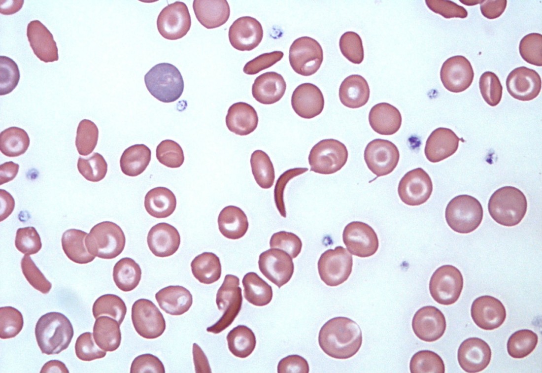 Cydan, NEA’s Orphan Drug Accelerator, Targets Sickle Cell With Startup Imara