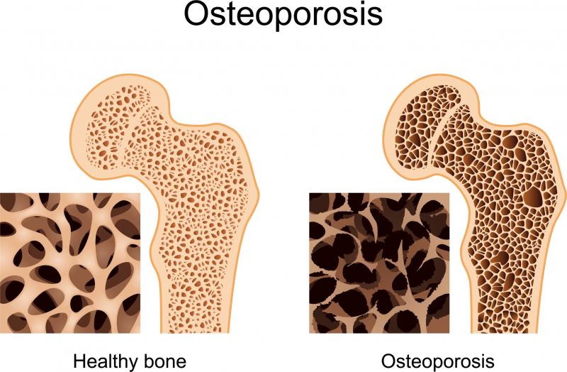 New Data Show Greater Bone Mineral Density Gains With Prolia® (Denosumab) Compared With Zoledronic Acid