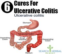 Effective Disease Management of Ulcerative Colitis