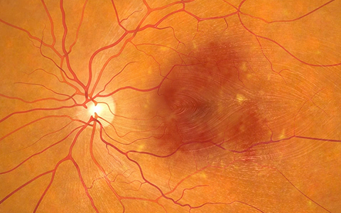 Ophthotech Completes Patient Recruitment of the Second Phase 3 Pivotal Trial of Fovista® Anti-PDGF Therapy in Combination with Lucentis® in Wet Age-Related Macular Degeneration