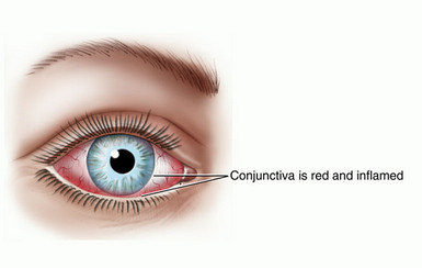 Eleven Biotherapeutics Completes Enrollment in Pivotal Phase 3 Study of Isunakinra (EBI-005) in Patients with Allergic Conjunctivitis