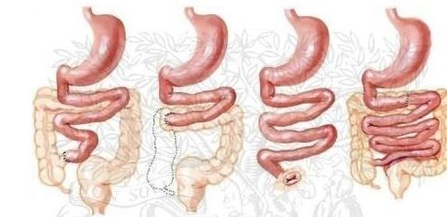 Zealand advances its proprietary, long-acting GLP-2 analogue, ZP1848, into clinical Phase II development for the treatment of Short Bowel Syndrome